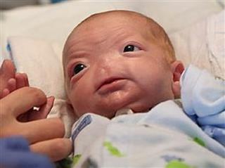Baby Born Without Nose