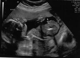 Abortion & Ultrasound