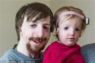 Treacher Collins Syndrome