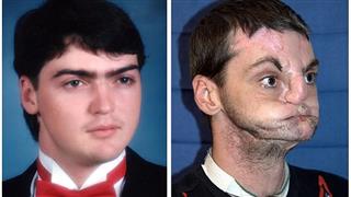 Face Transplant
