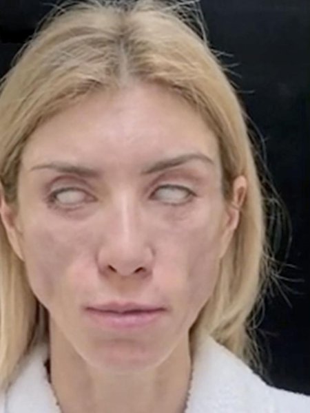 Yulia Tarasevich Plastic Surgery Goes Wrong