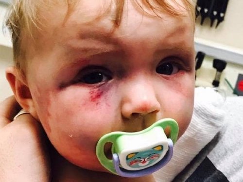 Evie Mcmahon Hit In The Face By Mother When 8 Months Old