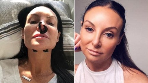 Fixing A Nose Job With Leeches