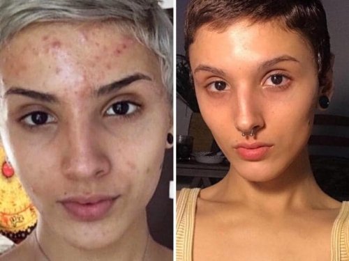 How She Cured Her Acne