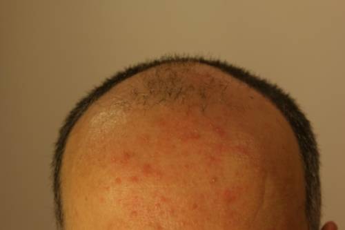 Hair Loss, What Causes It?