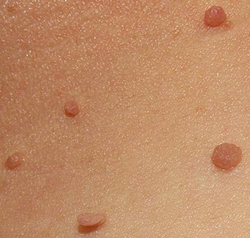 Skin Tags