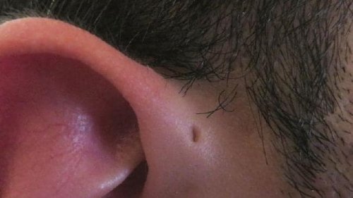 Preauricular Sinus And Cyst