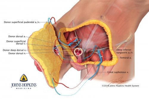 Total Penis And Scrotum Transplant