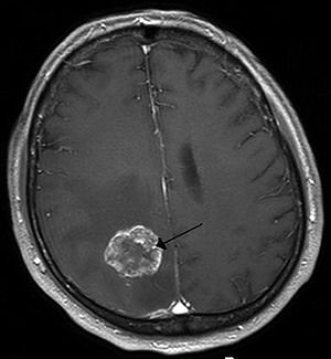 Brain Tumor