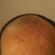   Hair Loss, Causes It